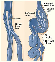 Varices Madrid