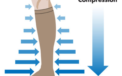 Medias de compresión, primera opción preventiva en varices