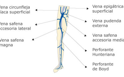 Insuficiencia Venosa Crónica de MMII
